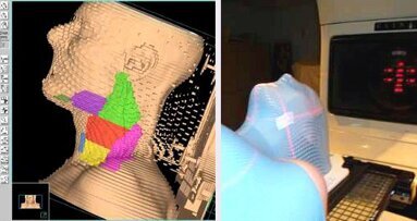 Un nouveau système de radiothérapie diminue significativement l'irradiation dans les zones saines