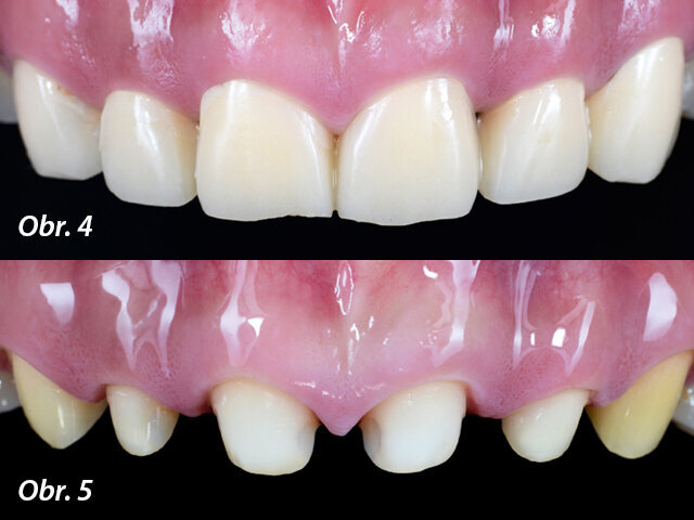 Obr. 4: Náhrady z provizorní kompozitní pryskyřice za účelem vyhodnocení funkce a estetiky / Obr. 5: Konečná preparace zubů