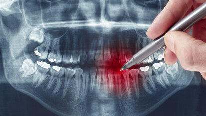 Parodontitis ist Männersache