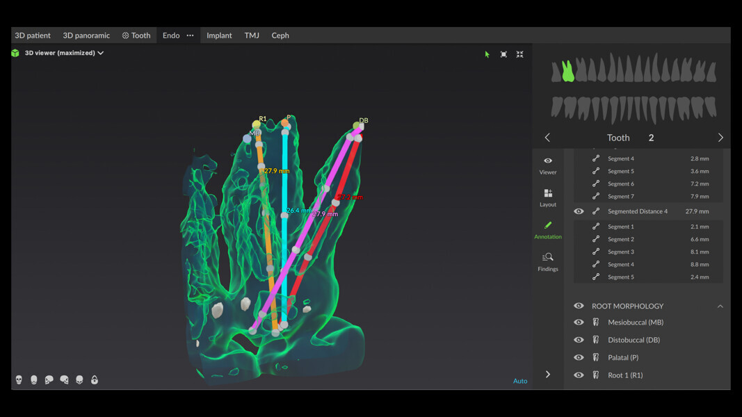 Fig. 4: 3D reconstruction of the canals in different colours, showing the detailed length segment by segment for each canal.