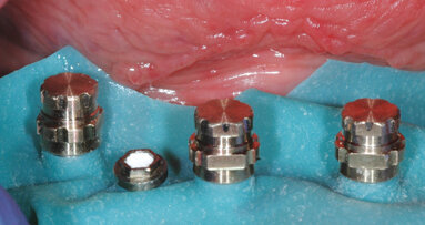 Možnosti ošetření bezzubého oblouku