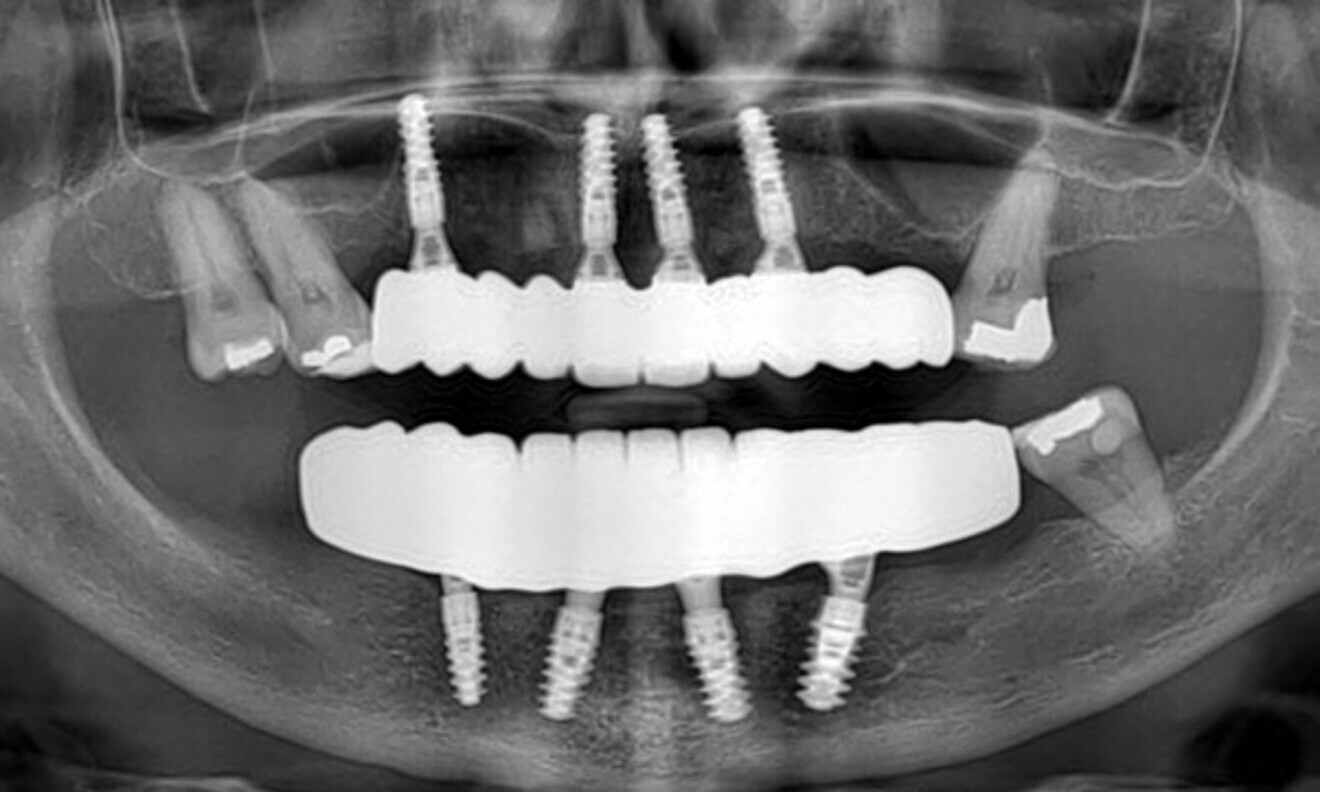 Fig. 84: The six-month post-op radiographic evaluation confirmed successful implant integration and stability.