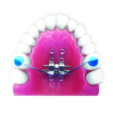 Fig.1 Bone-bone anchored designThe support arms can be temporarily bonded with composite to stabilize the expander for TAD insertion and cut off afterwards 