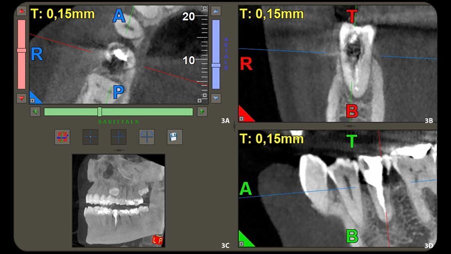 Figg. 3a-3d - Ricostruzione 3D della sezione assiale che mostra l’estensione in direzione mesiale-distale (a). Ricostruzione 3D della sezione sagittale che mostra l’estensione della lesione, direzione bucco-palatale (b). Sezione coronale della CBCT che mostra l’estensione della lesione periapicale e il difetto di riassorbimento (c). Scansione CBCT (d).