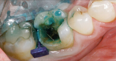 Korunka nebo onleje zhotovené v jeden den – ukázka klinického případu (Výhody nepřímých kompozitních náhrad)