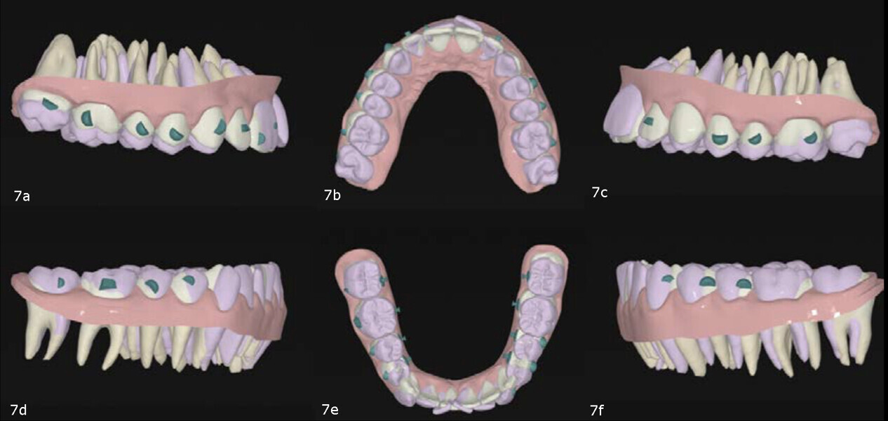 Figs. 7a–f: 3D superimposition of the planned movements.