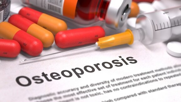 Kieferosteonekrosen im Zusammenhang mit Osteoporose-Behandlung