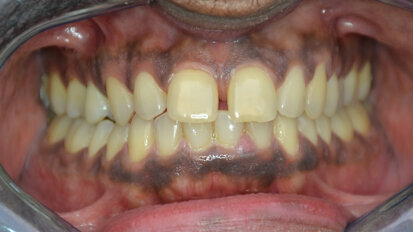 Considerations for the use of a universal composite in the anterior region