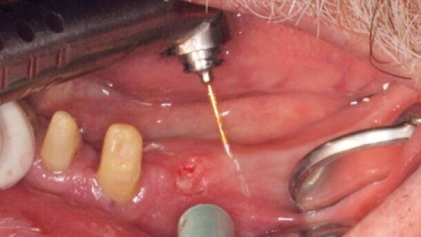 Innowacyjne sposoby usuwania tkanek przy użyciu lasera Er:YAG