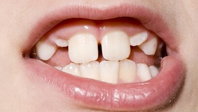 Wady zgryzu trzeba leczyć!