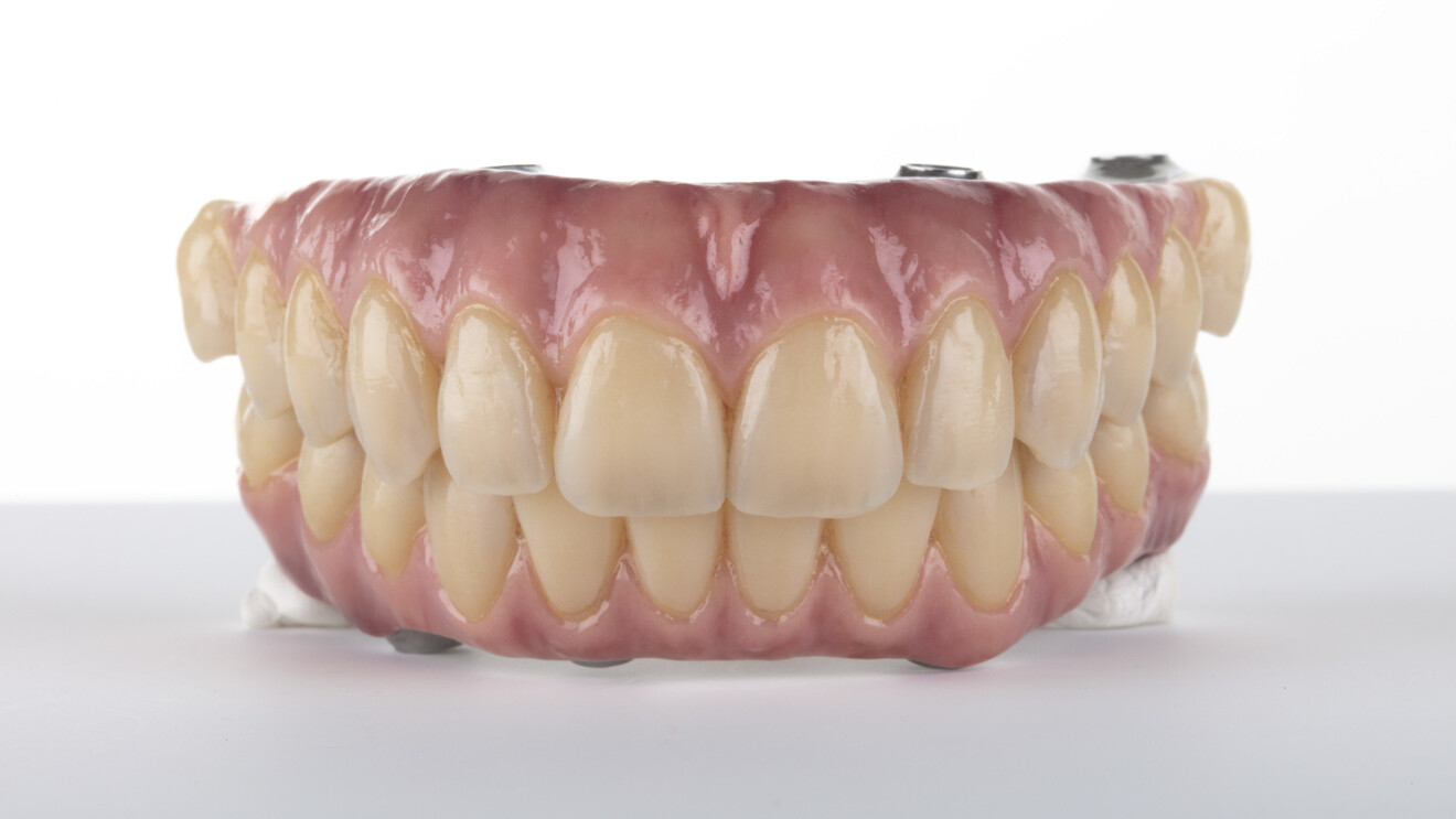Fig. 18a: Definitive screw-retained, porcelain-veneered maxillary and mandibular full-arch prostheses before delivery.
