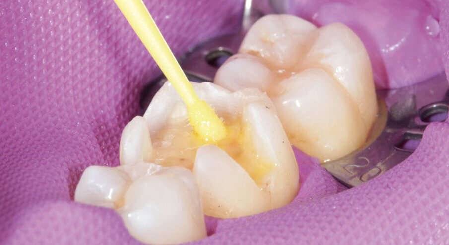Fig. 9: Conditioning the prepared tooth with Adhese Universal for 20 s, followed by drying with air