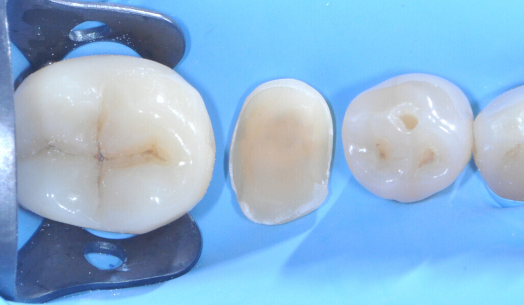 Fig. 17: Tooth structure after selective etching, rinsing and drying. 
