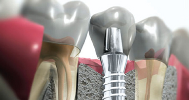 Cursos de implantología en la Cayetano Heredia