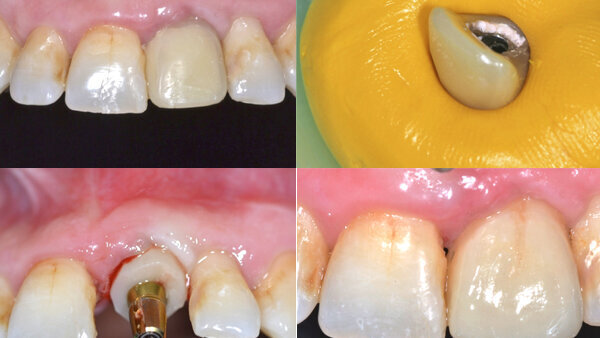 Técnica alternativa de impresión para la reproducción del perfil de emergencia