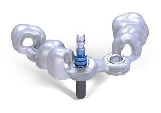 Straumann Guided Surgery