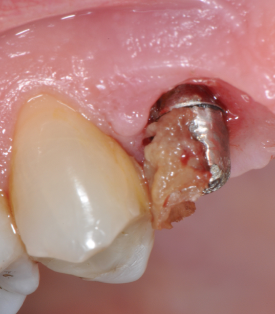 Fig.4: Case 1. Clinical appearance after the prosthetic crown removal. 