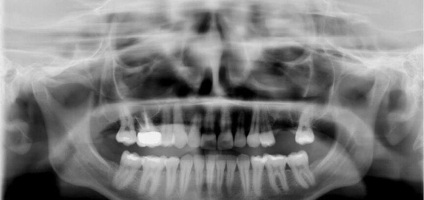 Fig. 14: Dental panoramic tomogram of initial situation.