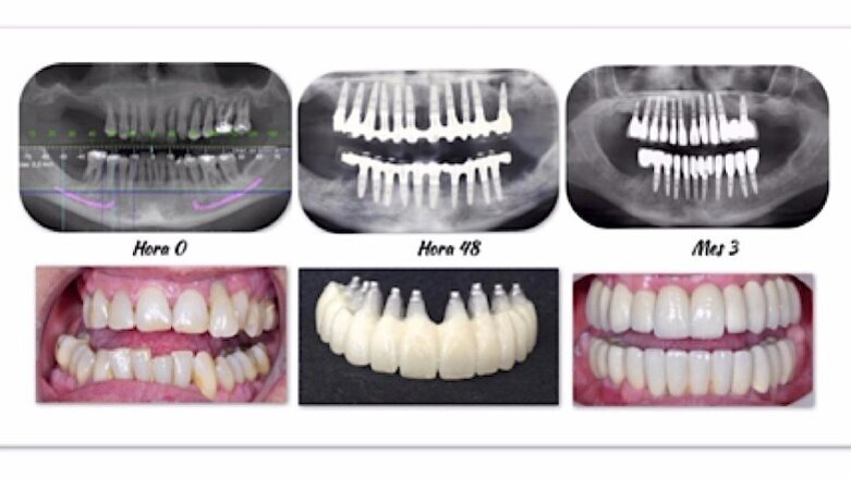 Los beneficios de la implantología biodinámica