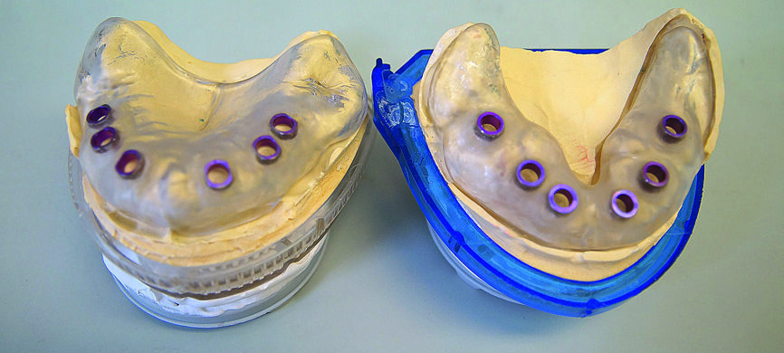 Fig. 13 : Gabarit de forage totalement « navigués » après planification CBCT.