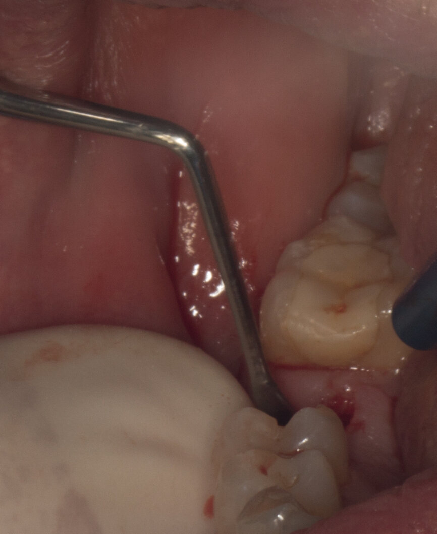 Ryc. 10 i 11_Widok preparacji łoża.