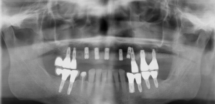 Fig. 11: Post-op dental panoramic tomogram.