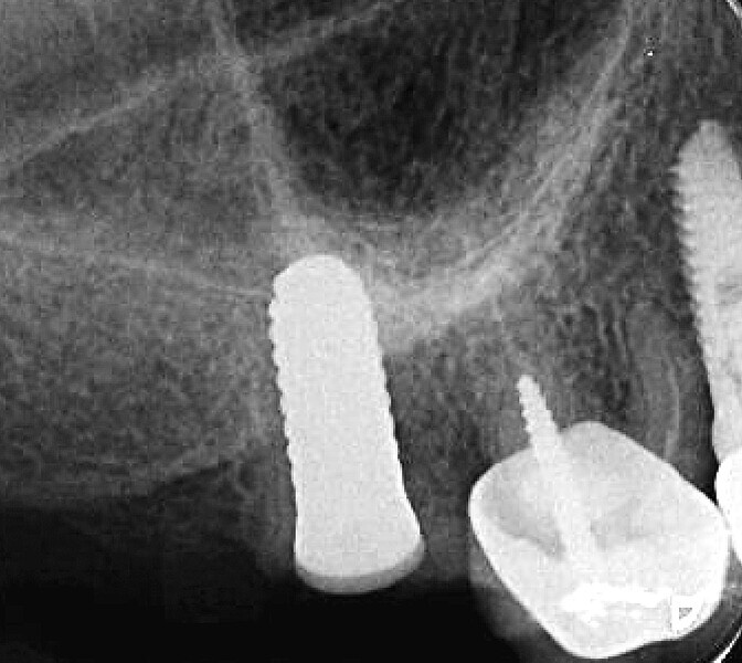 Fig. 56 : Intégration tissulaire et radiographie de contrôle à deux mois.