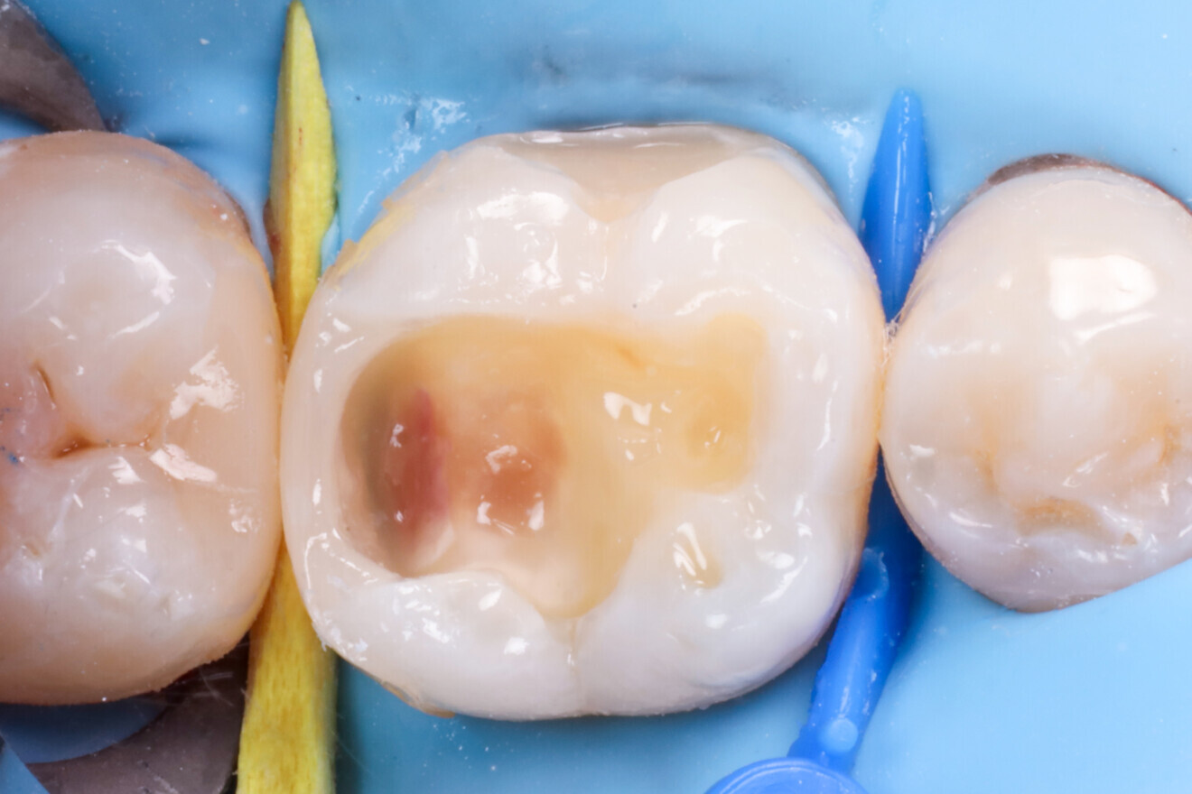 Fig. 8: Proximal wall built incrementally with composite.