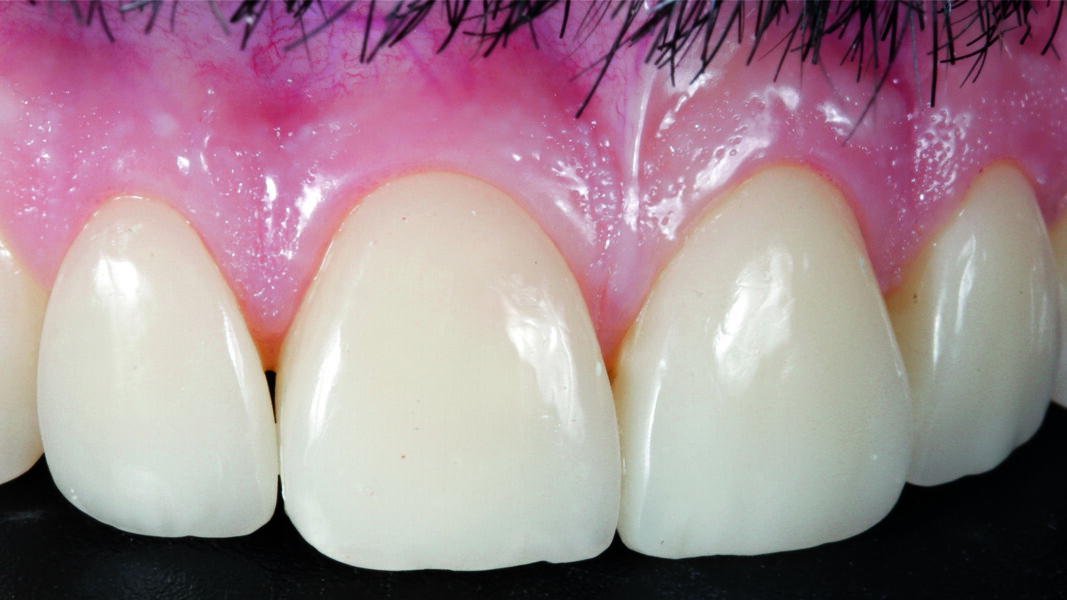 Fig. 19: Final result, right lateral view.