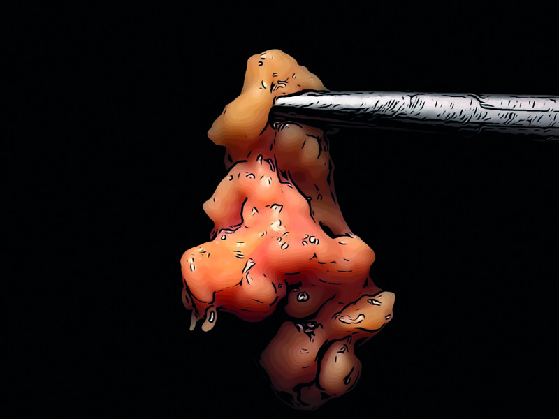 Fig. 13 : Corps adipeux de la joue excisé.