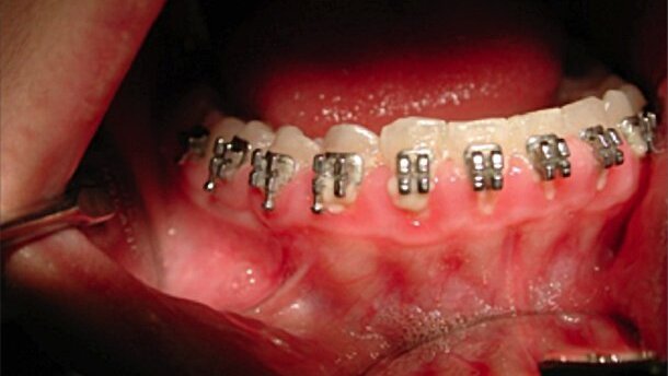 Gengivoplastica eseguita con Laser CO<sub>2</sub> coadiuvato dalla tecnologia LED