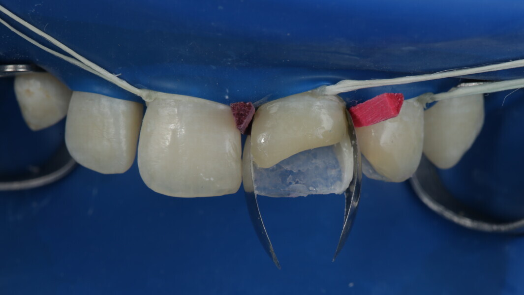 Fig 22: Distal wall was built with A2 body shade.