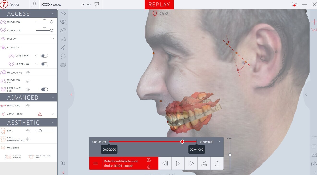 Fig. 7: Mandibular dynamics in Twim (Modjaw). 