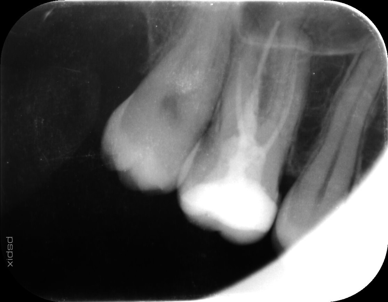 Fig. 2: Initial radiograph showing radiolucent areas in the apical region, indicating incomplete root canal filling.