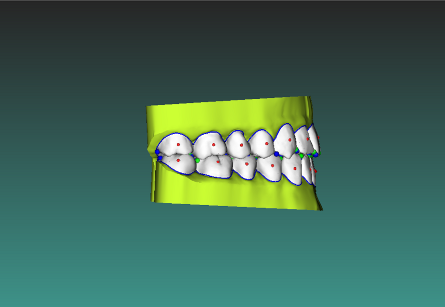 Figs. 8a–e: Final position set-up for the first phase of treatment.