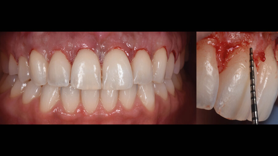 Fig. 15_Fine intervento e suture palatali.