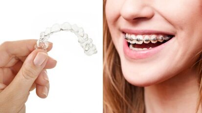 Gouttières transparentes ou appareil dentaire fixe