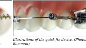 Khí cụ chỉnh sửa cấp tốc (Quick-fix) dành cho sai khớp cắn loại III giả