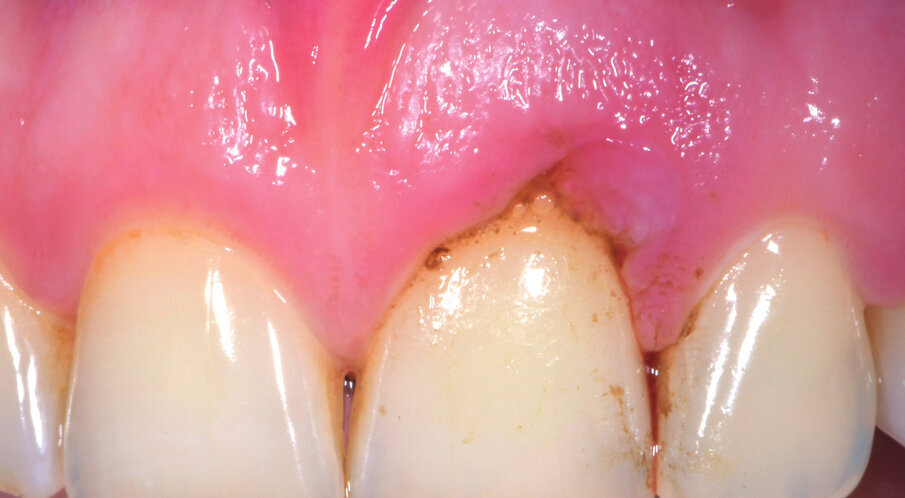 Fig. 3 - Applicazione di Ozosan per 2 min.