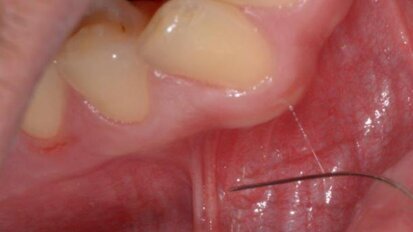 Kilka (z wielu) technik bezpiecznego i bezbolesnego znieczulania