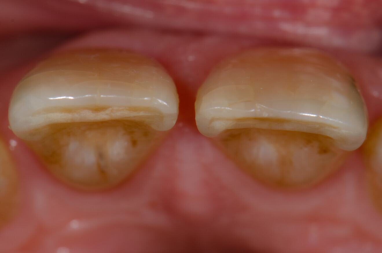 Fig. 1c: Initial intra-oral photographs of tooth #11, occlusal view.
