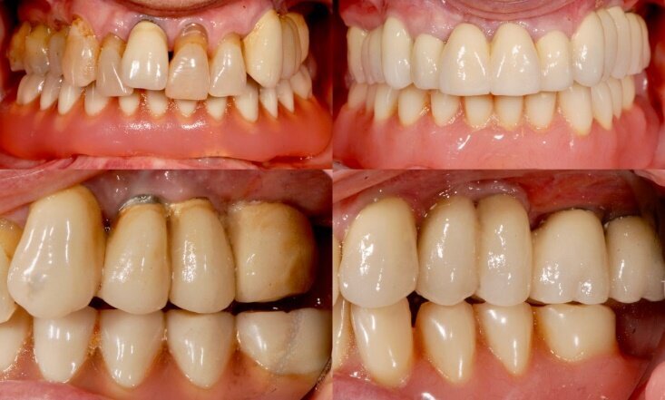 Fig. 7 - Confronto tra la condizione prima (sinistra) e dopo la riabilitazione (destra).