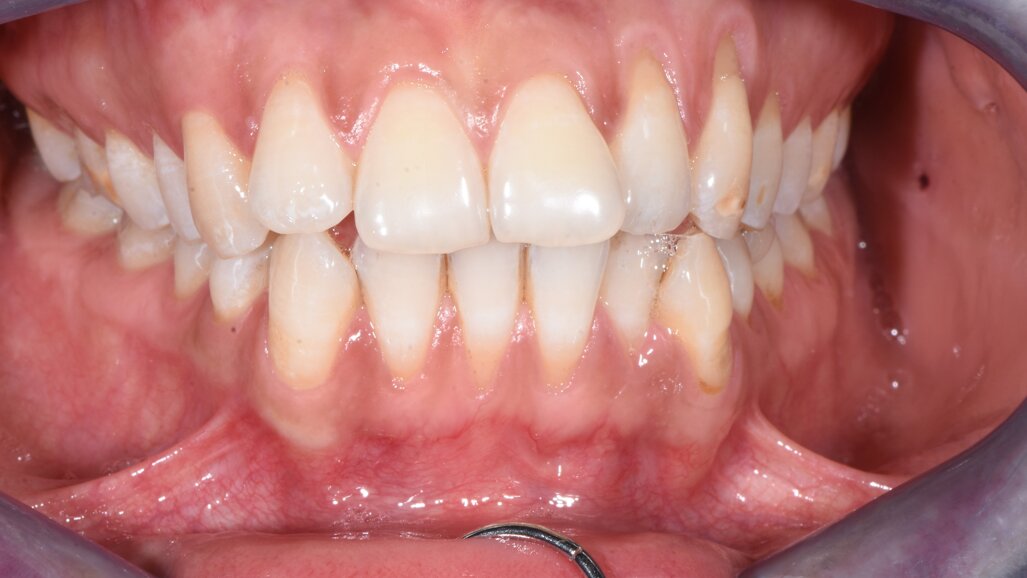 La gestione dell’IPR nei casi ortodontici con allineatori trasparenti