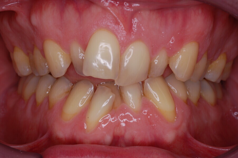 Fig. 45–50: Sequential frontal intra-oral photographs illustrating progressive levelling and alignment and uprighting of the mandibular right lateral incisor.
