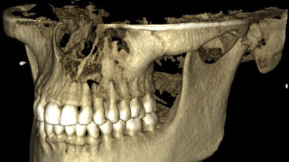 New perspectives in periapical surgery: Flap detachment and retraction