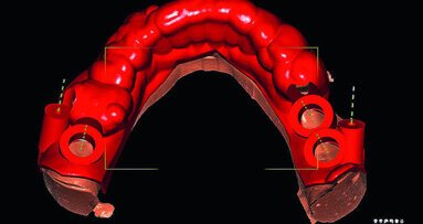 Comparison of guided and non-guided implant placement accuracy (Part 1)