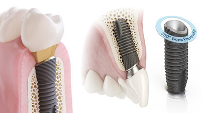Astra Tech OsseoSpeed Profile EV ‒ L’impianto specificamente studiato per creste inclinate. Segue il profilo naturale.