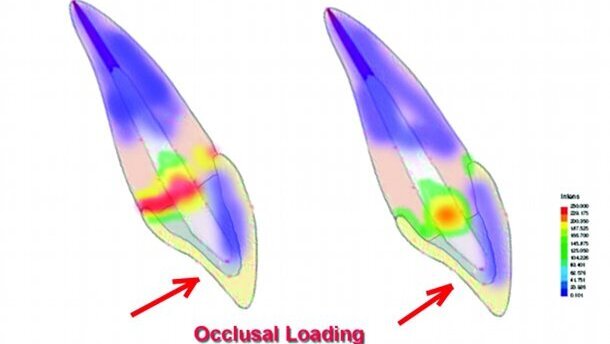 Restauration de dents traitées endodontiquement : un abord sous l’angle technique