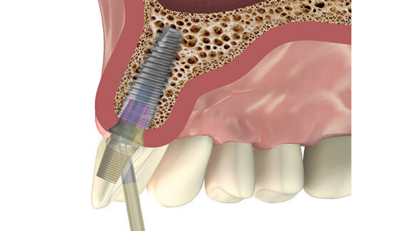 Un nuevo pilar que puede colocarse en distintos ángulos