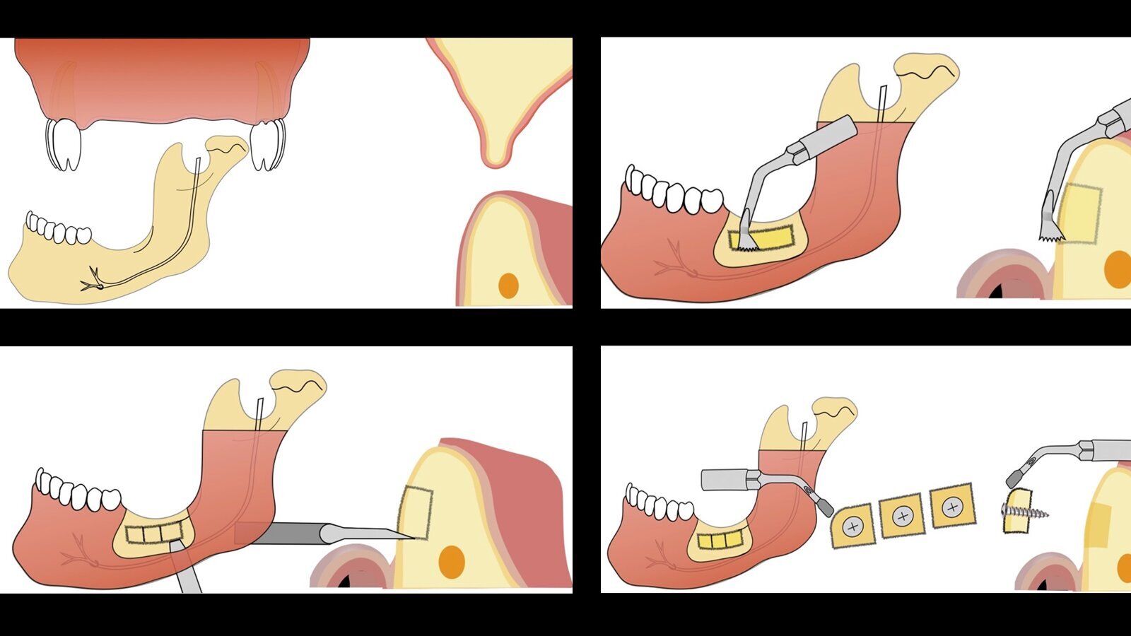 Piezocirugía  (10). Efectividad del piezoeléctrico en la terapia ósea regenerativa